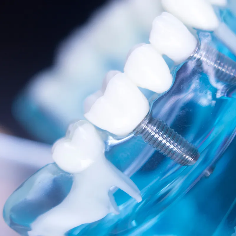implants2 oxford dentistry