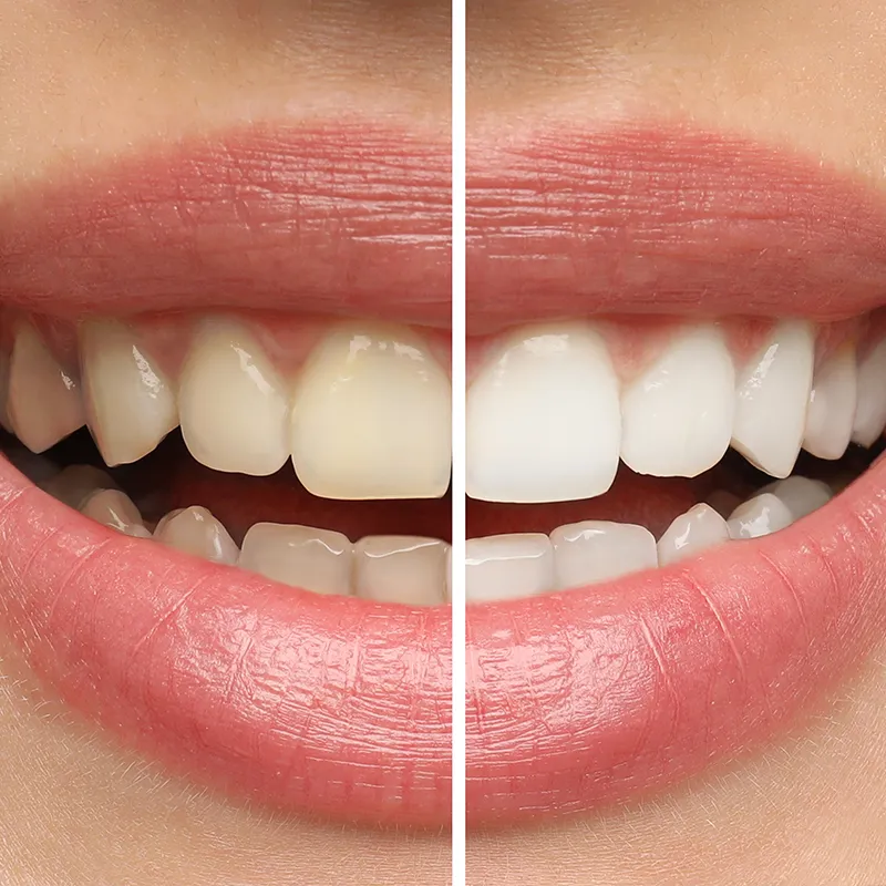 whitening